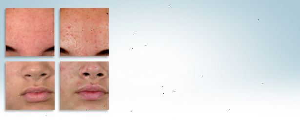 Hoe de positieve gevolgen van acne te zien. Accepteer je acne hebt.