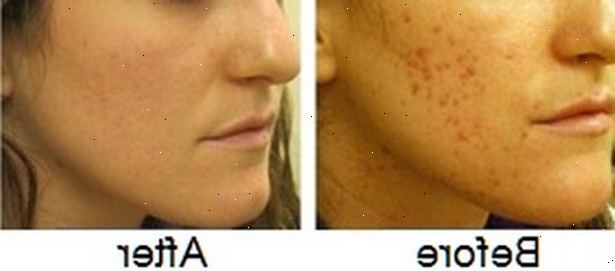 Hoe zich te ontdoen van littekens en snijdt achtergelaten door acne. Erachter te komen wat voor soort littekens zijn op uw huid.