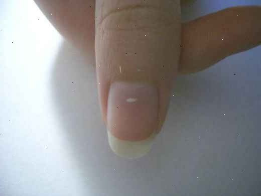 Hoe zich te ontdoen van die witte vlekken op je nagels. De oplossing is om gewoon hen in staat stellen te groeien.