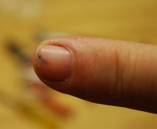 Hoe maak je een splinter onder je nagel te verwijderen. Neem een medisch geschikte hoeveelheid ibuprofen gebaseerd op het etiket informatie.