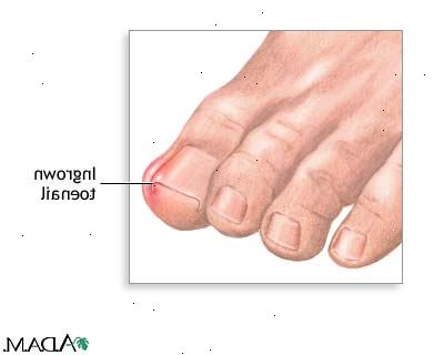 Hoe zich te ontdoen van ingegroeide teennagels. Geniet van je voet in een mengsel van warm (of zo heet als je kunt staan) water en Epsom zout.