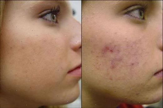 Hoe zich te ontdoen van acne in 1 dag. Probeer wat benzoylperoxide.