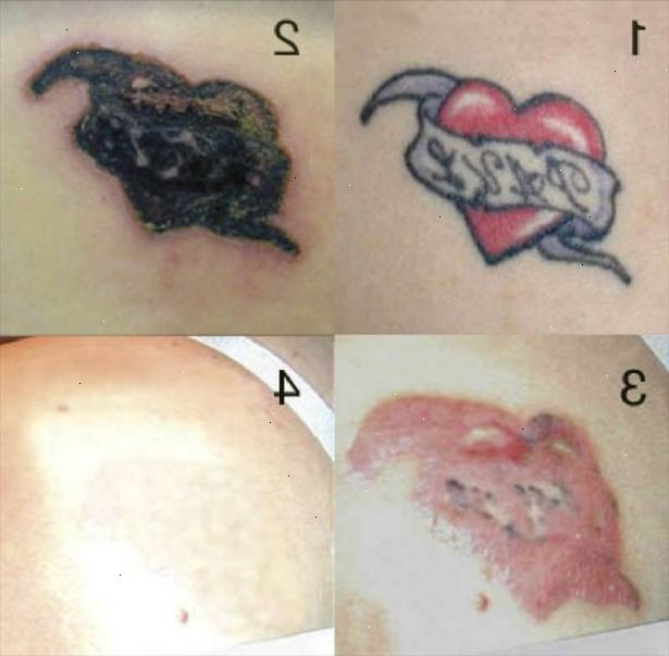 Hoe maak je een tatoeage te verwijderen. Overwegen om uw tatoeage professioneel verwijderd.