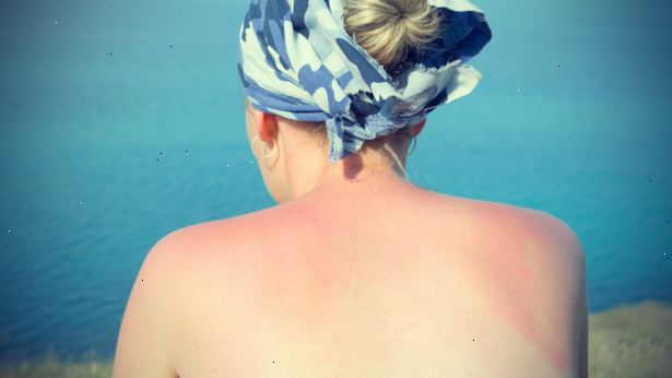 Hoe zich te ontdoen van een jeukende zonnebrand (eerlijke huid). Neem een goede warme no-soap douche.