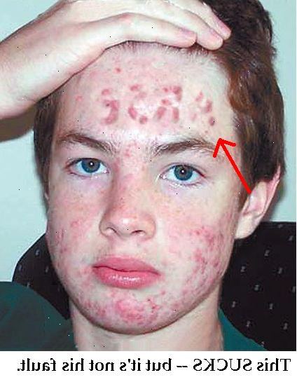 Hoe je snel te ontdoen van acne. Gebruik vervangingen voor de gevoelige huid.