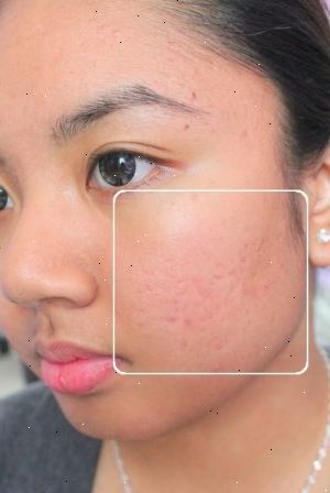 Hoe u het uiterlijk van littekens te verminderen van je gezicht. Te ontdoen van acne littekens met rozenbottel zaad olie.